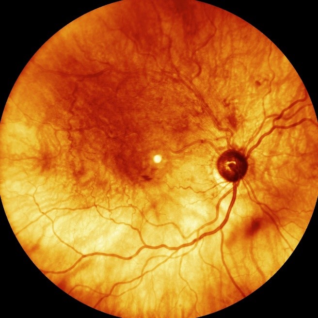 Dramatic Resolution of Recalcitrant Cystoid Macular Edema after Concurrent Intravitreal Injection of Bevacizumab and Triamcinolone