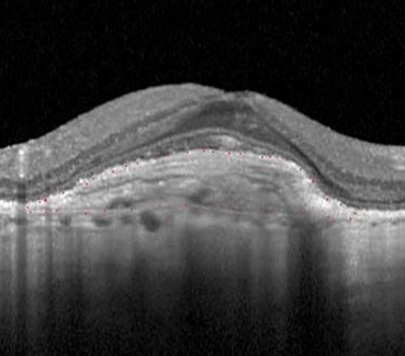 Intravitreal Bevacizumab in Neovascular Age-Related Macular Degeneration as First Choice: a New Italian Ruling